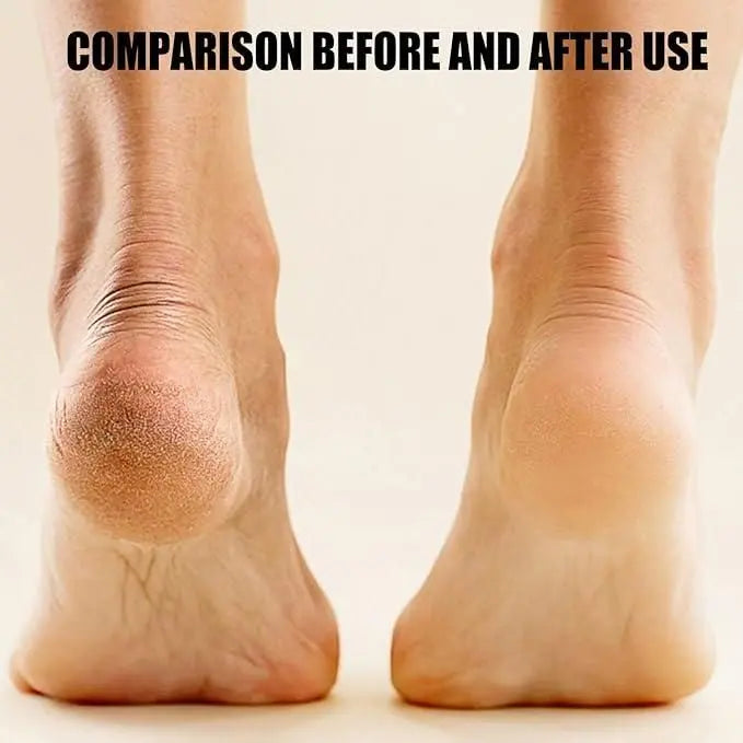 Electronic Pedicure Tool - CrazySuperStore